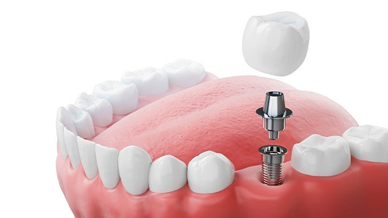 diagram showing the parts of a dental implant 