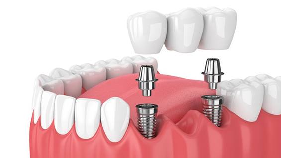 Illustration of implant bridge