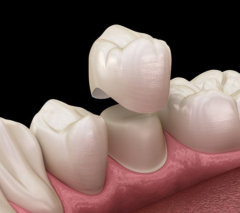 Dental crowns are deluxe fillings