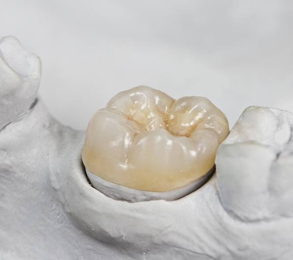 Dental crowns can repair a variety of tooth problems in one treatment