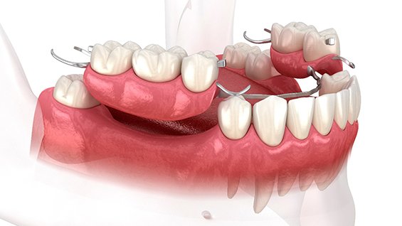 3D render of a partial denture