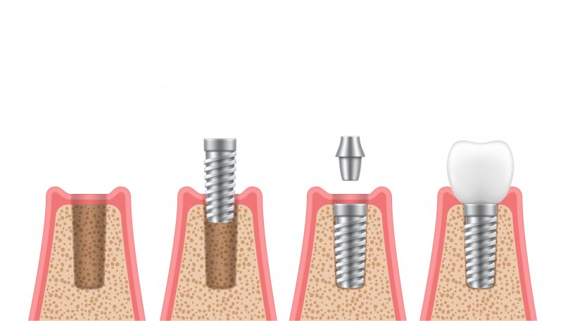 Illustration of dental implant placement